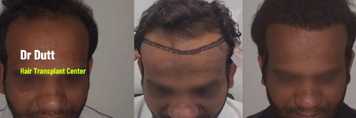 Dr. Dutt Hair Transplant Center – Affordable Hair Transplant Clinic in Delhi NCR